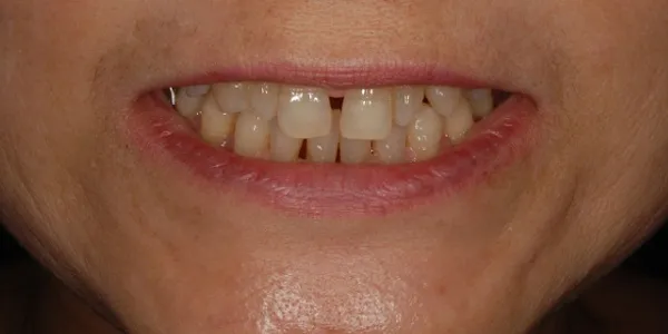 前方・口元(開)