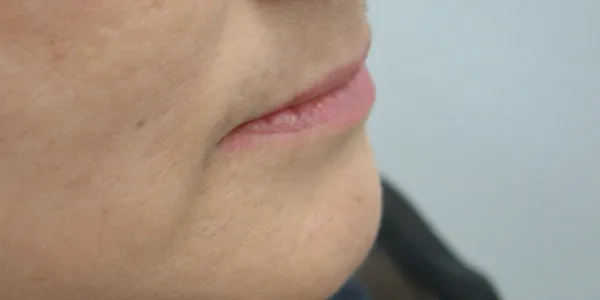 側方・口元(閉)