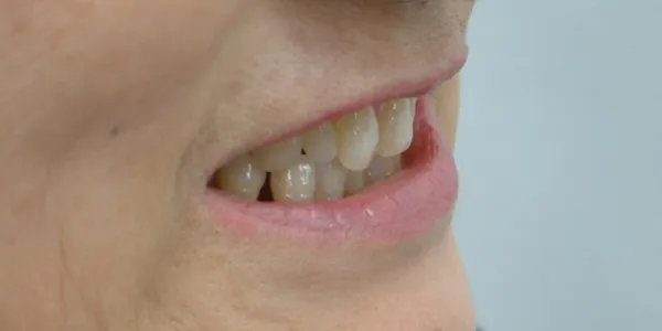 側方・口元(開)