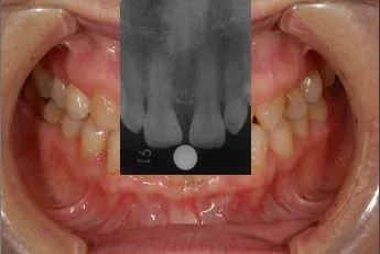 口腔内の分析・治療計画